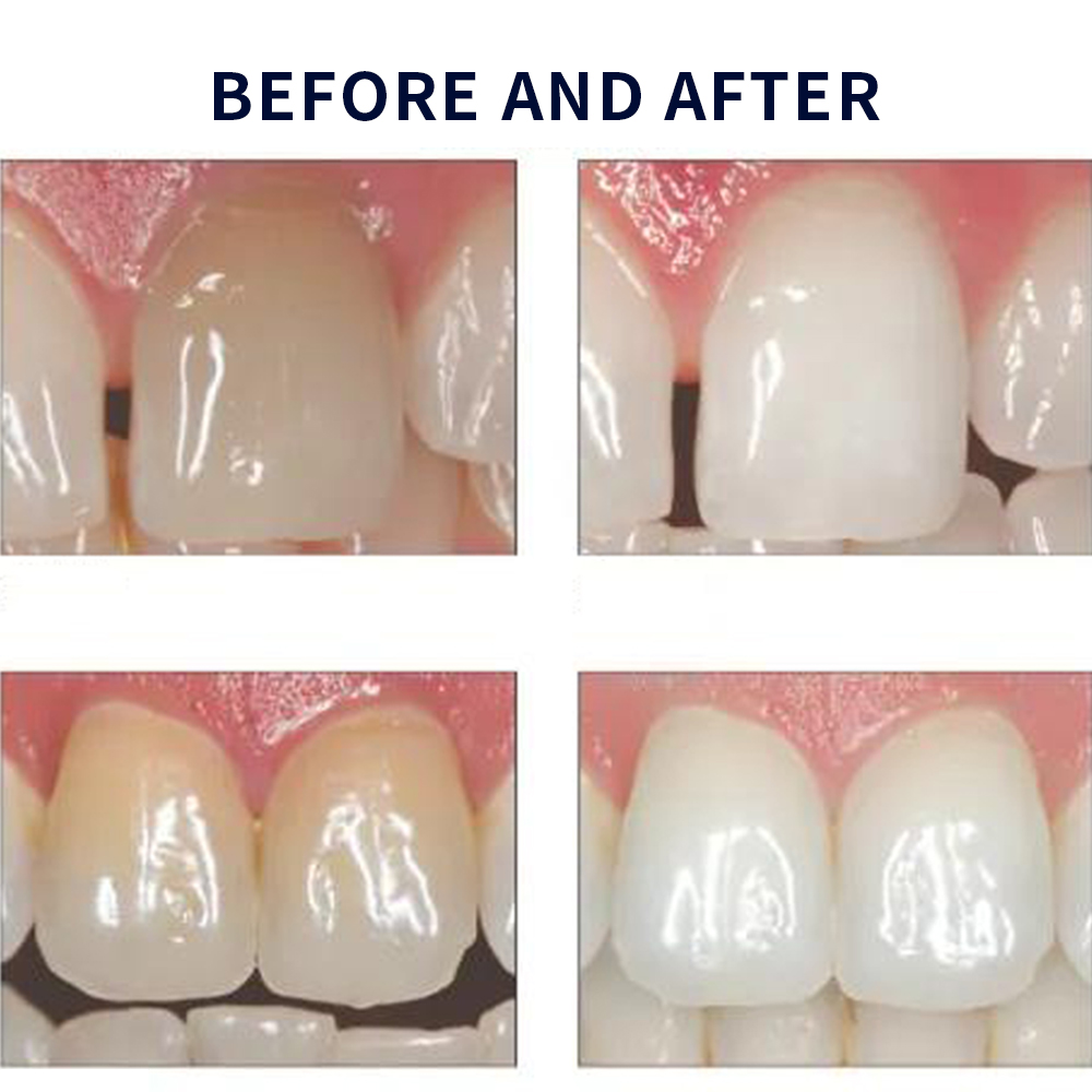 Opalwisdom-Kit de Blanchiment  - Teeth Whitening Foam avis et prix