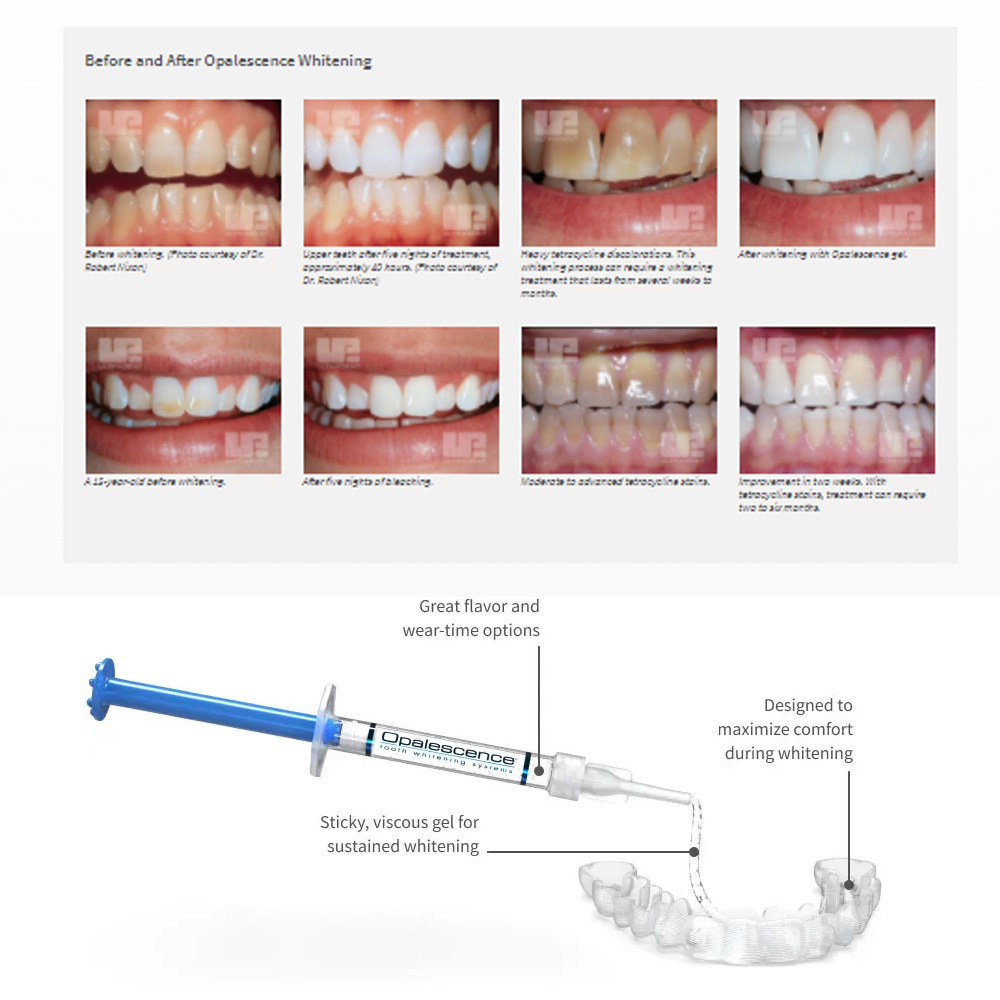 Opalwisdom-Kit de Blanchiment  - Teeth Whitening Foam avis et prix