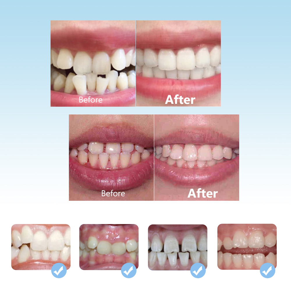 Ensemble de bretelles orthodon - Teeth Whitening With Braces avis et prix