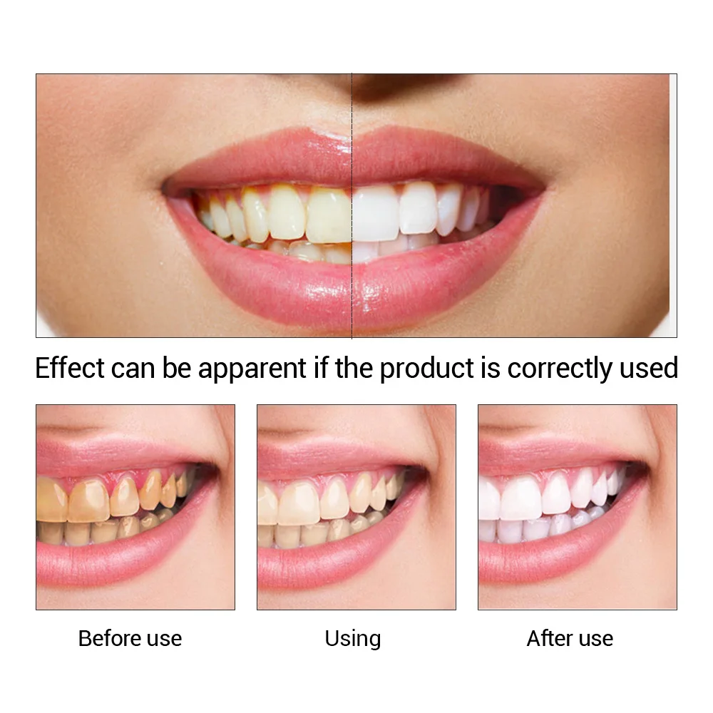 FTEENPLY poudre d'essence de b - Teeth Whitening Results avis et prix