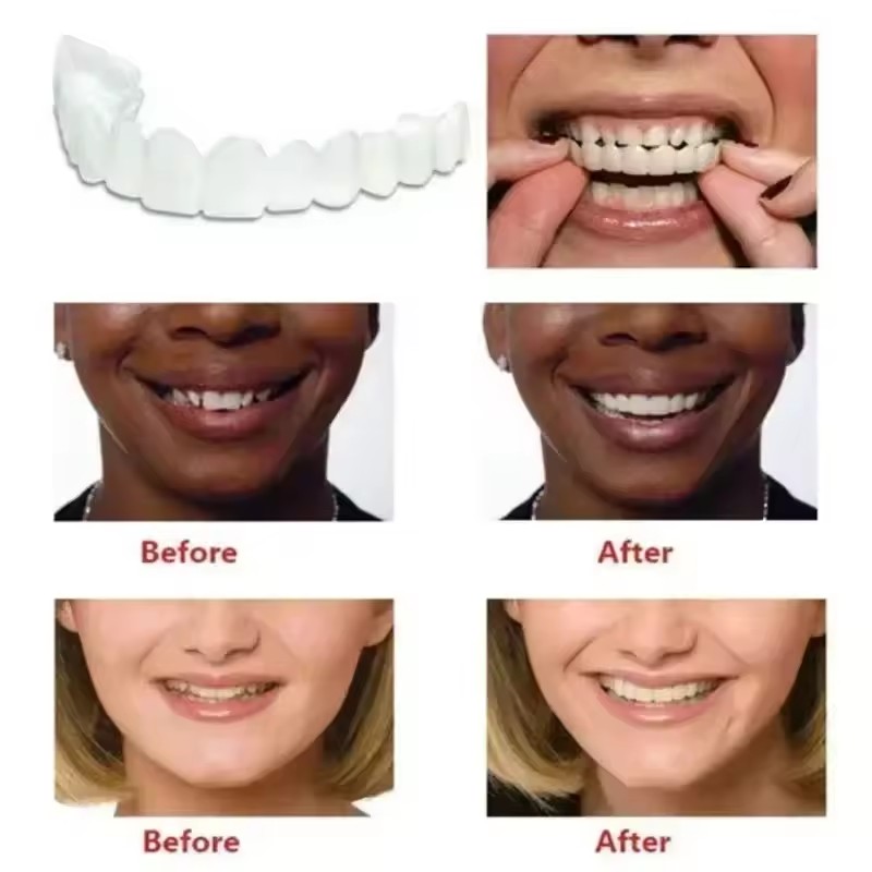 Veneers dentaires blanchissant - Teeth Whitening With Braces avis et prix