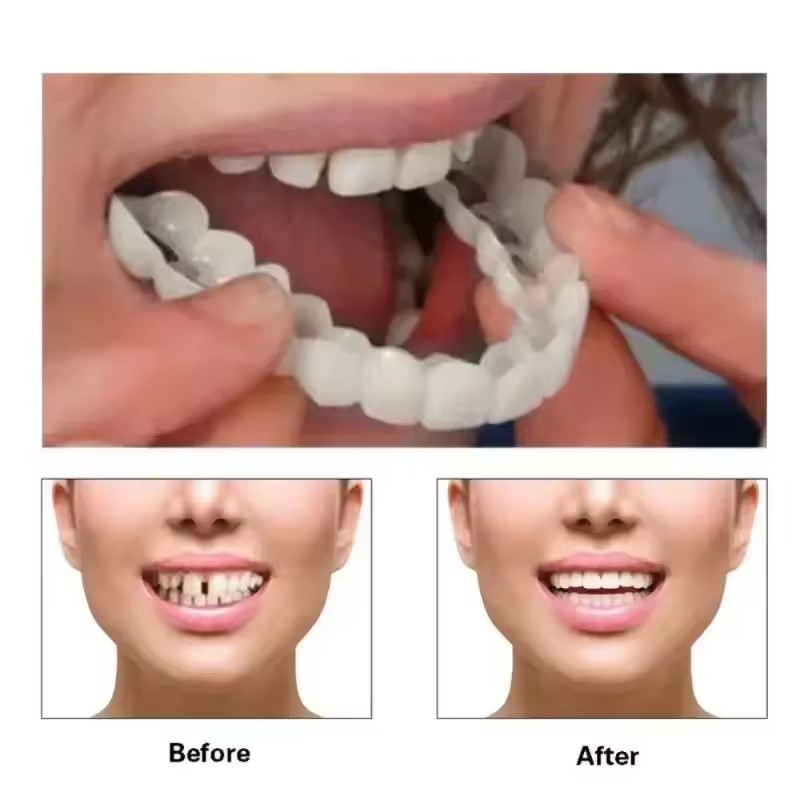 Veneers dentaires blanchissant - Teeth Whitening With Braces avis et prix