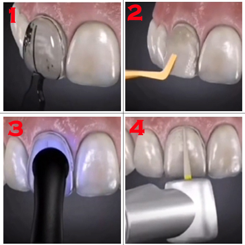 Moule dentaire pour placages e - Teeth Whitening Lab avis et prix