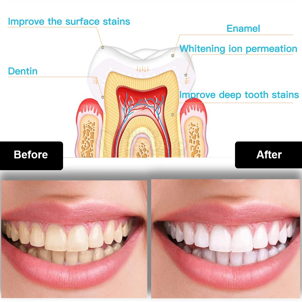 Kit de blanchiment des dents d - Teeth Whitening Led Kit avis et prix